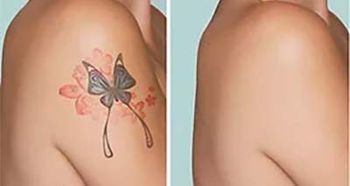 Produkter til fjernelse af tatoveringer