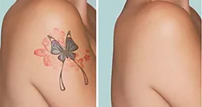 Fjernelse af tatovering